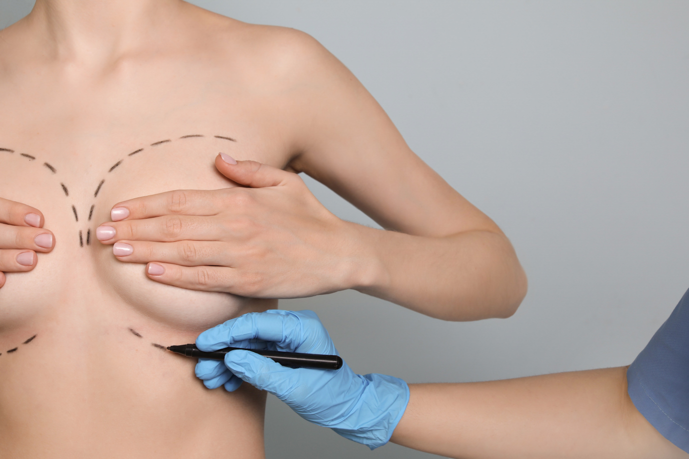 Aumento de busto (implantes de mama) - Dr Luque